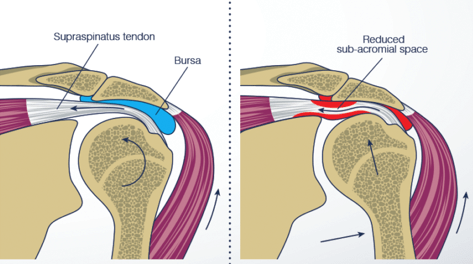 Why Does Shoulder Pain Occur? What Can I Do To Stop It?